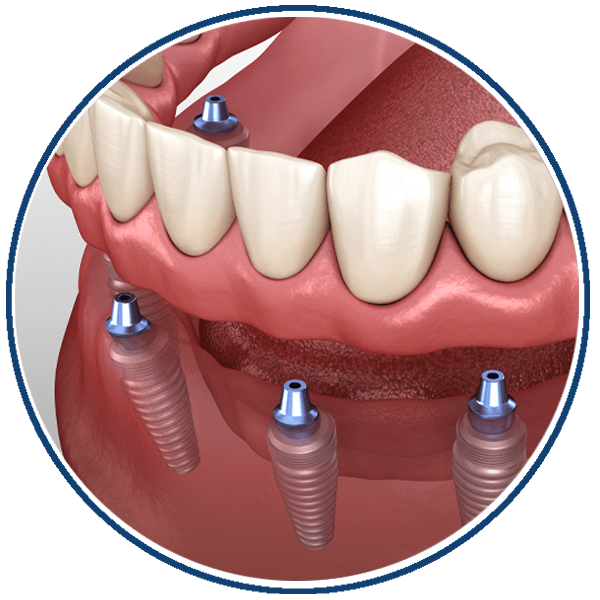 full mouth dental implants.