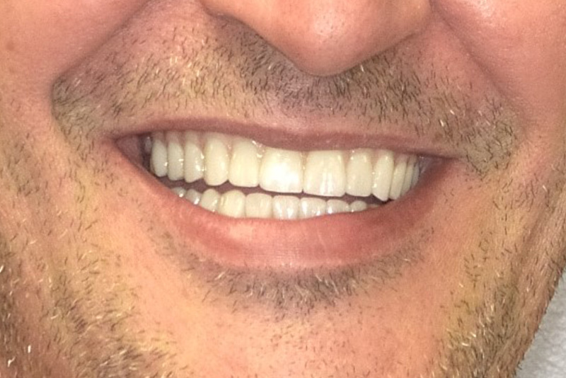 Dr. Fetsch Before and after case