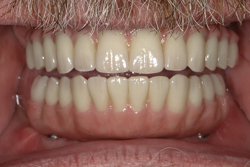 Dr. Fetsch Before and after case