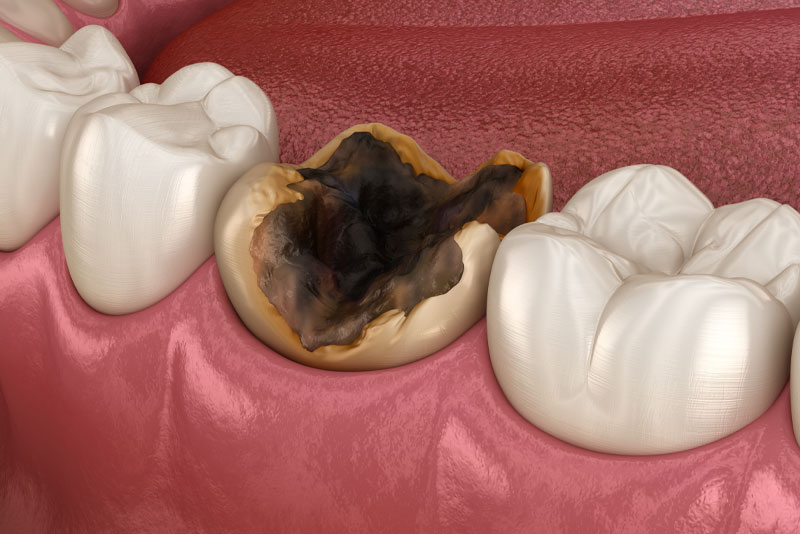tooth showing cavity right before tooth extraction