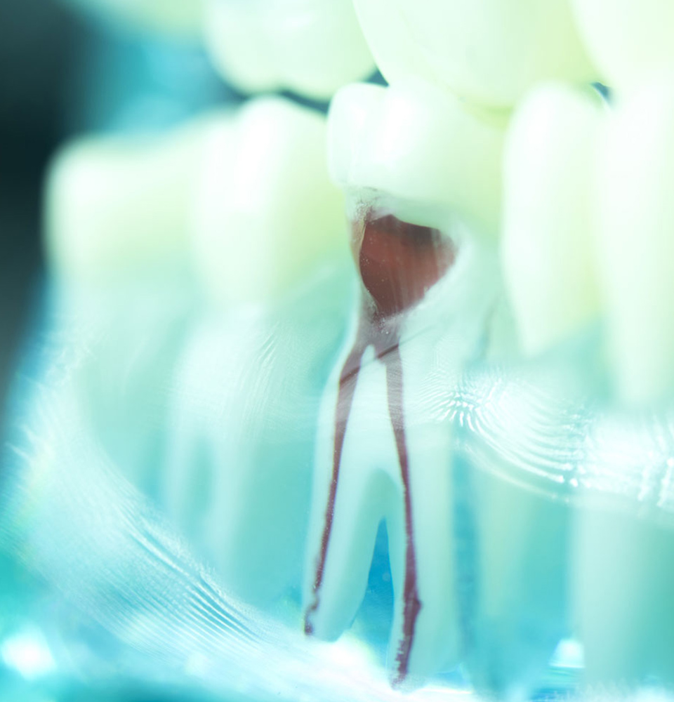 root canal model