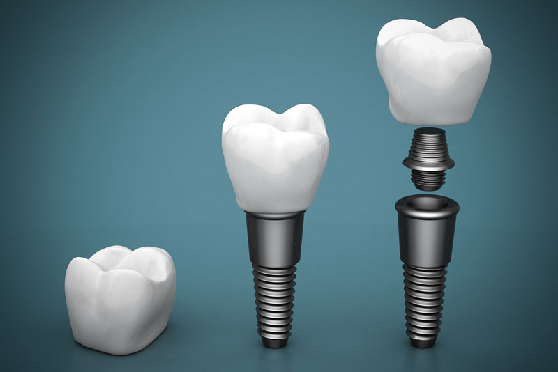 beneficial dental implants that have a dental implant post, an abutment, and a crown.