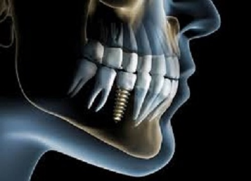 Dental-Implant-Jaw-Side-image.