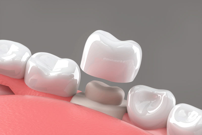 Preparated molar tooth for dental crown placement. Medically accurate 3D illustration