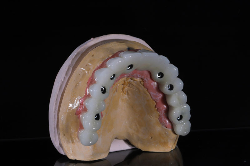 all on x dental implants with a full arch of teeth being held by them