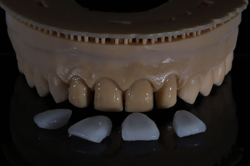4 veneers infront of a model ready to be placed onto it