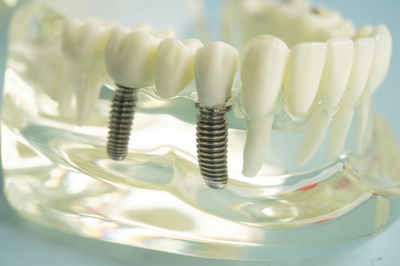 2 implants held into the jaw of a clear model