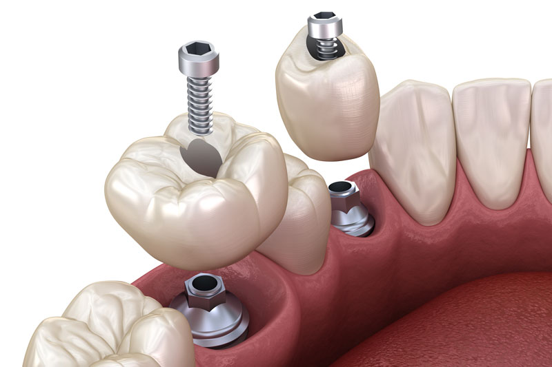 2 single dental implants with a crown on top and a screw to match