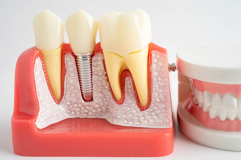 a dental implant with a full arch next to the model