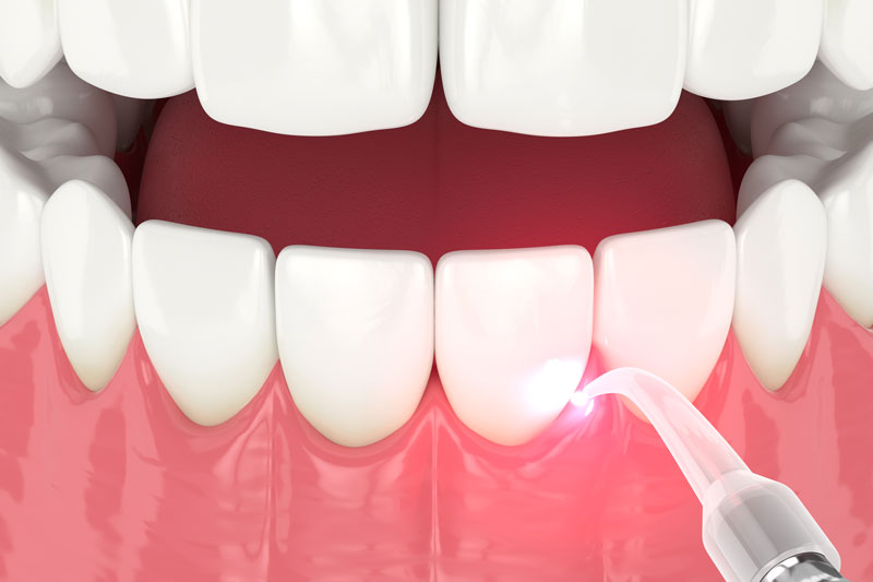 Lanap Laser Gum Surgery being performed on teeth