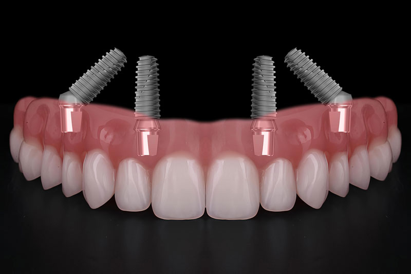 all on 4 dental implants with a full arch of dental implants going across it