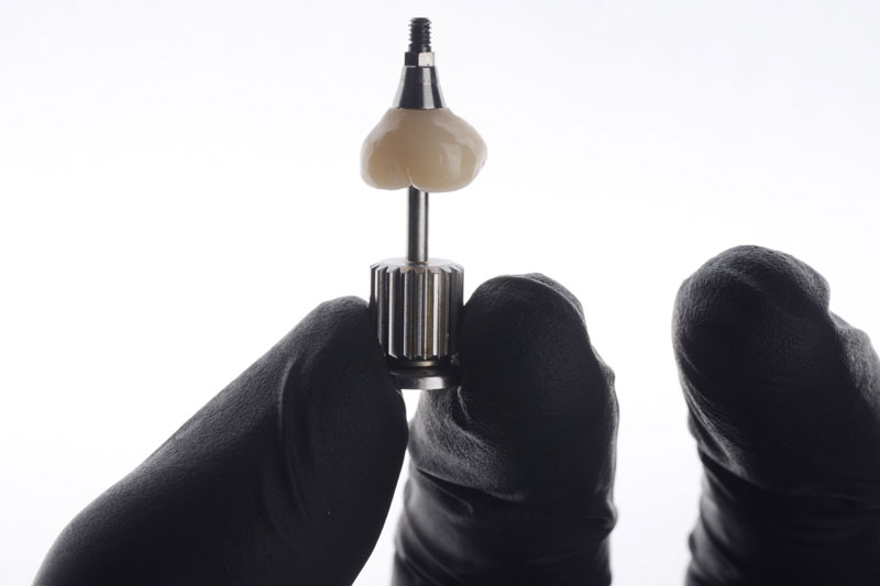 a single dental implant with a crown on top