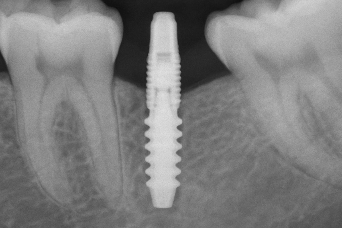 An x-ray image showcasing an endosteal implant integrated into the jawbone, highlighting its placement and stability. No text on the image.