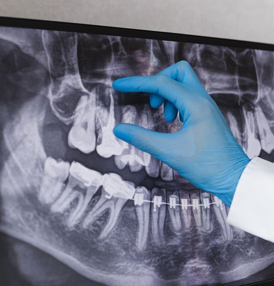 Doctor points to filled root canal in dental x-ray