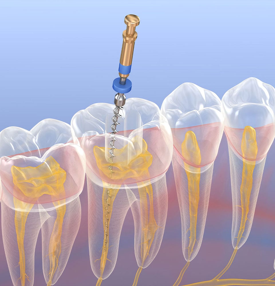 root canal illustration