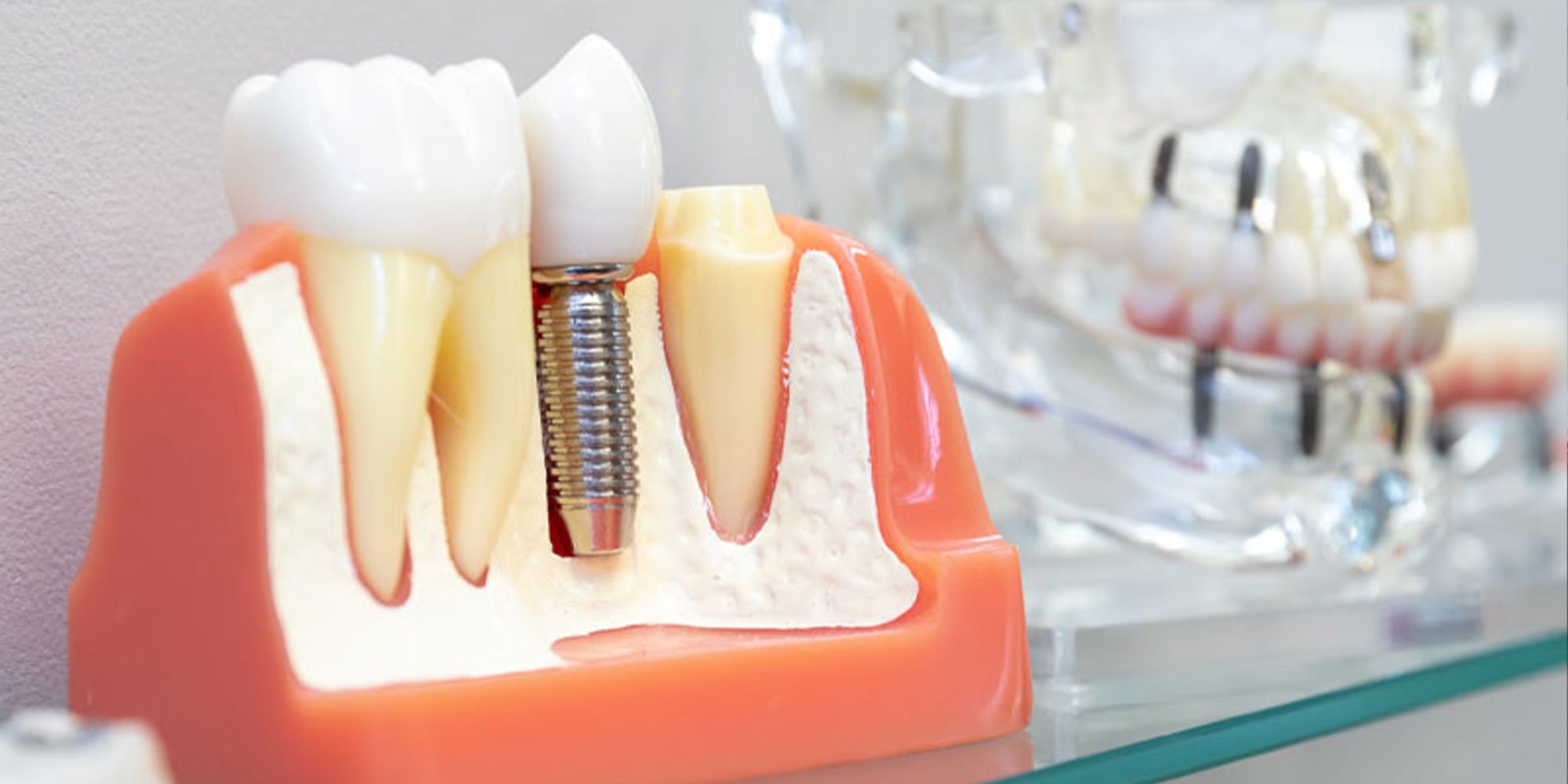 close up model of dental implant model