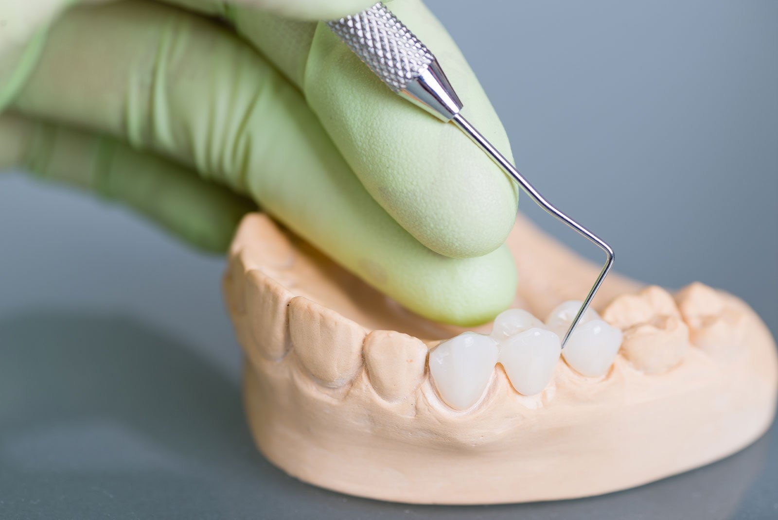 close up model of a dental bridge