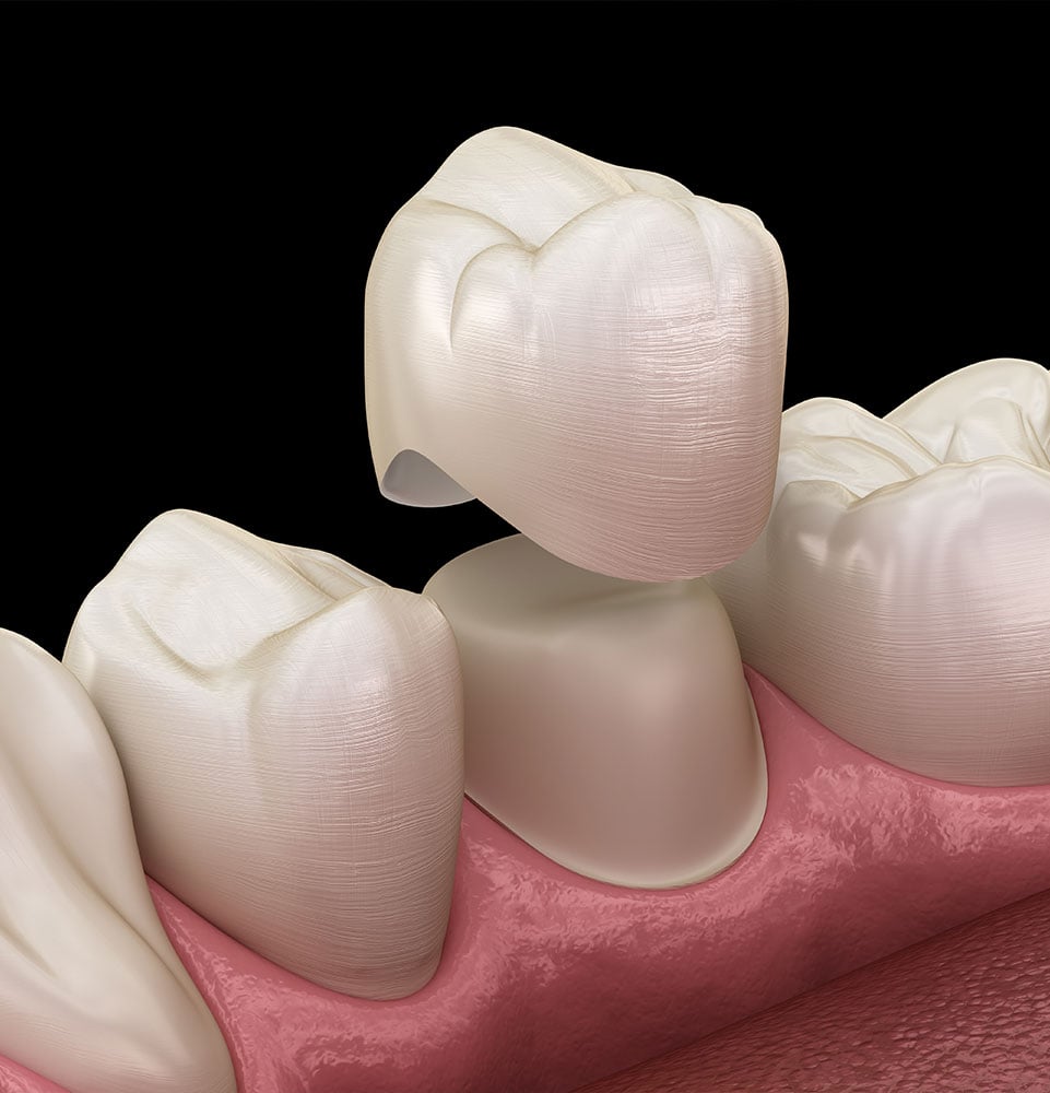 Dental crown premolar tooth assembly process