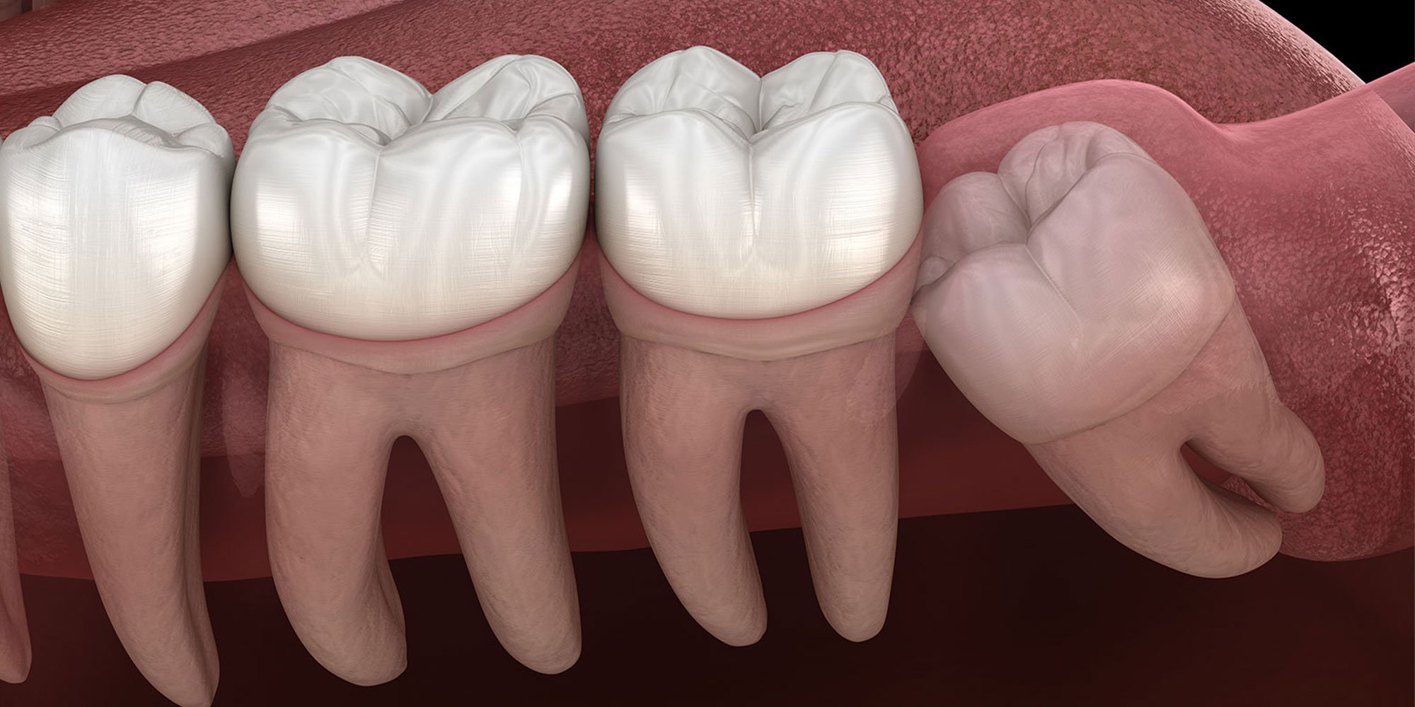 Wisdom tooth with impaction at molar tooth.