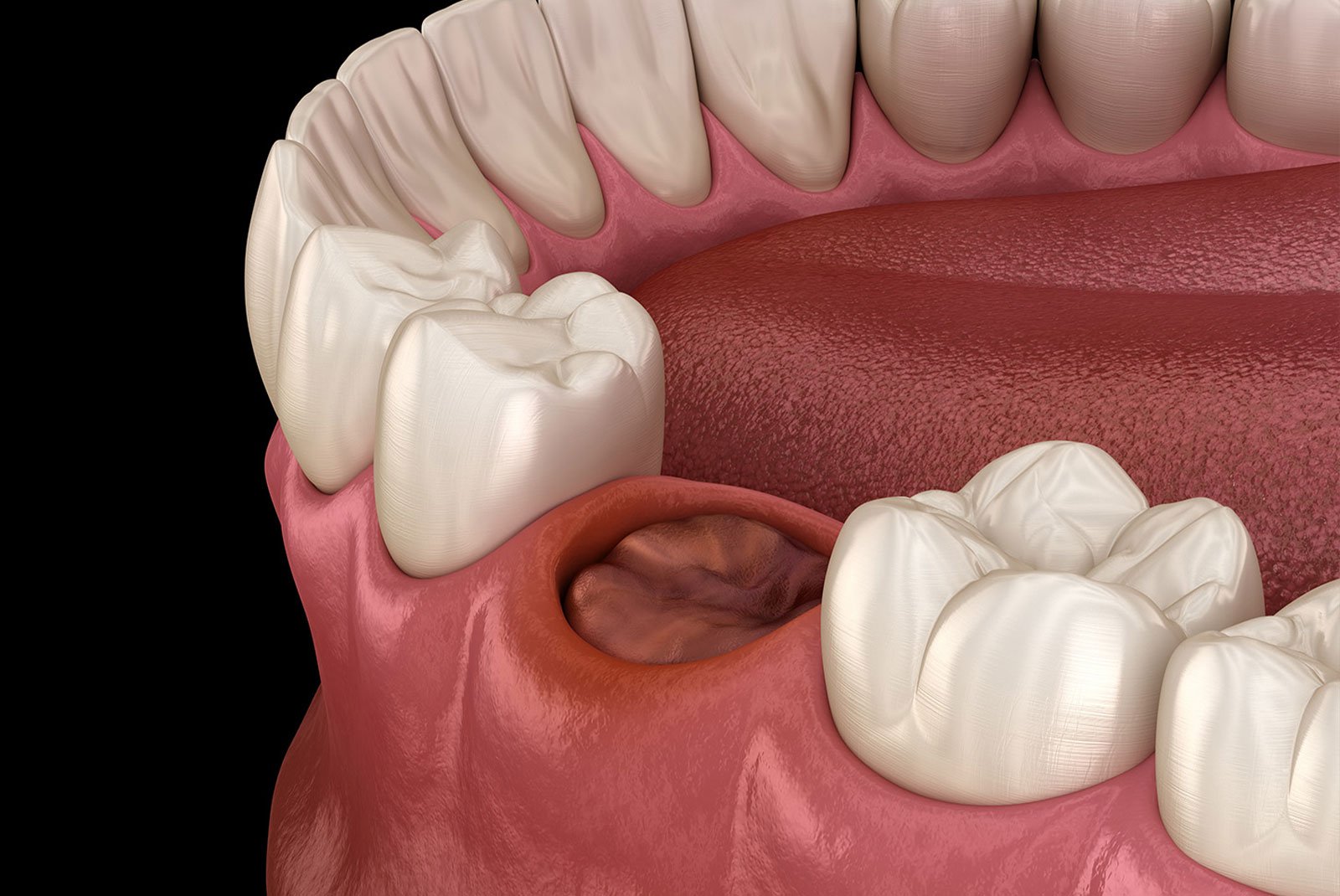 illustration of missing tooth with tooth extraction