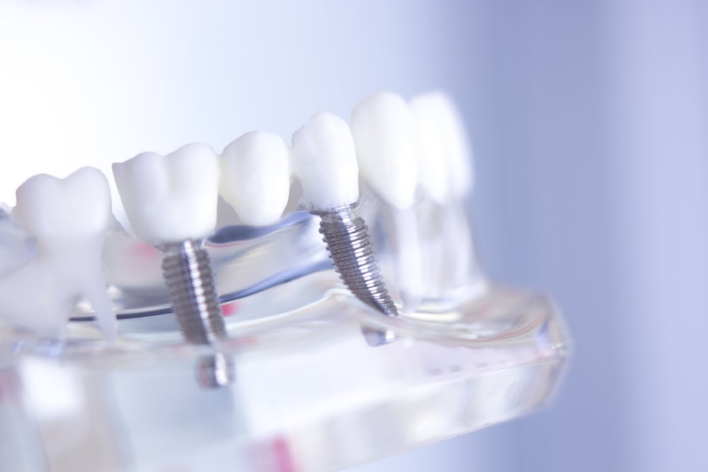 Dentist consulting with a patient about dental implant recovery in a warm, modern office