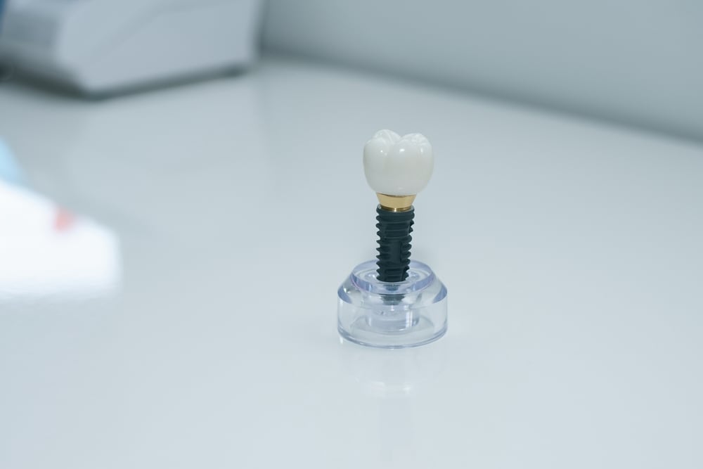 Do You Have Enough Bone for Dental Implants? Key Considerations