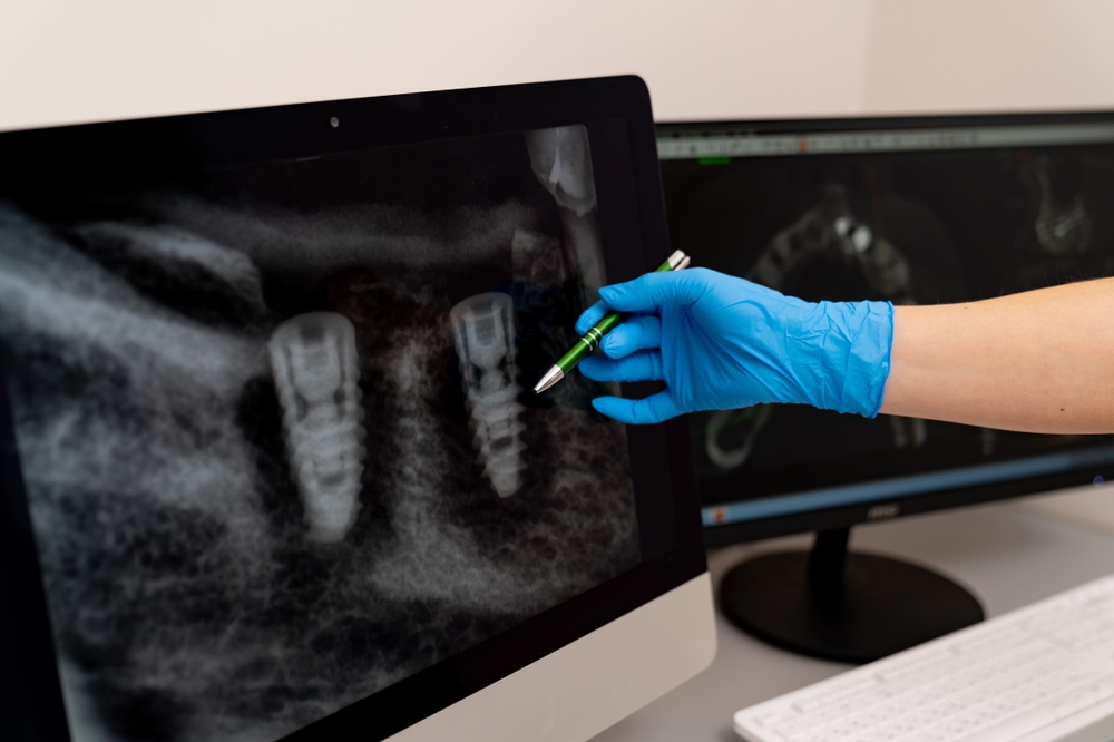 Are Dental Implants Worth the Cost? An In-depth Analysis